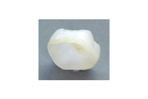 ジルコニア｜審美歯科｜渡辺歯科