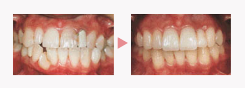 ダイレクトボンディング法・ラミネートベニア法｜審美歯科｜渡辺歯科