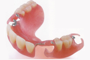 エステティックデンチャー｜バネのない入れ歯｜渡辺歯科