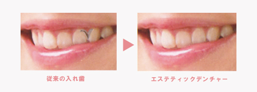 エステティックデンチャー｜審美歯科｜渡辺歯科