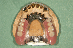 ミリングデンチャー｜金属床の入れ歯｜渡辺歯科