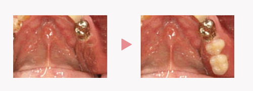 ＯＰＡデンチャー｜金属床の入れ歯｜渡辺歯科