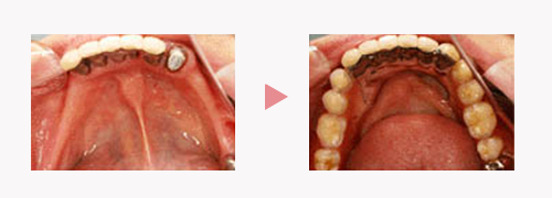 コーヌスデンチャー｜金属床の入れ歯｜渡辺歯科