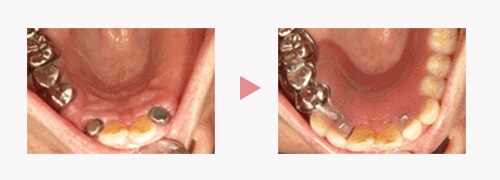 磁性アタッチメント｜磁石の入れ歯｜渡辺歯科