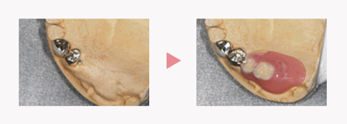 磁性アタッチメント｜磁石の入れ歯｜渡辺歯科