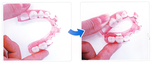 ソフトデンチャー｜やわらかくてバネのない入れ歯｜渡辺歯科