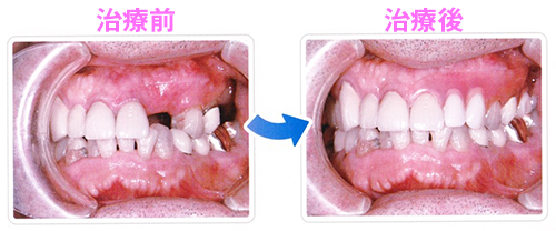 ソフトデンチャー｜治療前と治療後の装着例です｜渡辺歯科