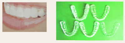 マウスピースによ歯列矯正治療アクアシステム｜渡辺歯科