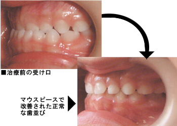反対咬合治療器ムーシールド｜渡辺歯科