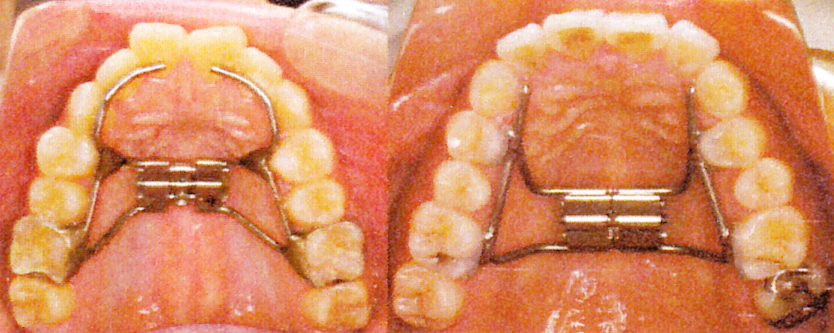 顎拡大法｜渡辺歯科