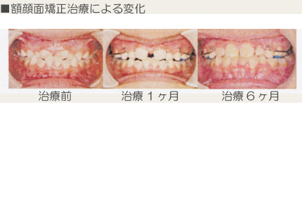顎顔面矯正治療｜渡辺歯科