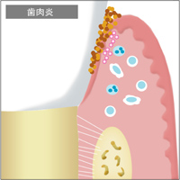 口腔内の免疫機能　歯周治療について｜渡辺歯科