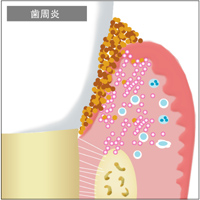 口腔内の免疫機能　歯周治療について｜渡辺歯科