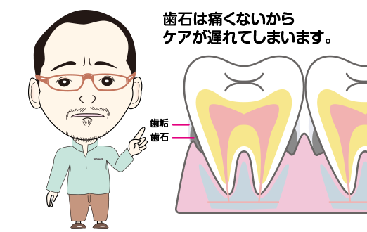 歯石のお手入れ！