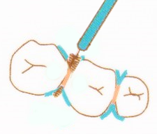 歯間ブラシの磨き面